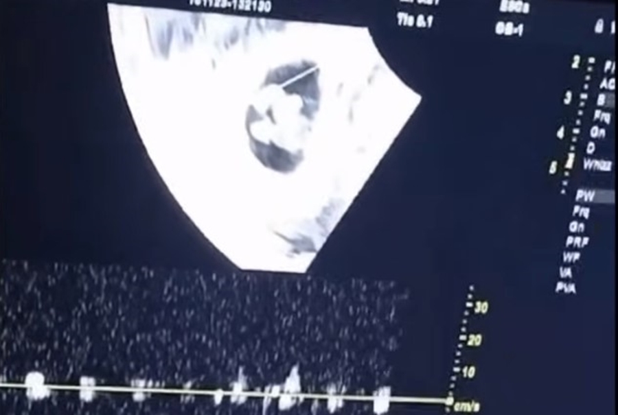 VÍDEO: Jovem de 18 anos descobre gravidez de quíntuplos