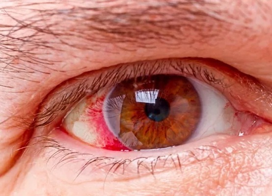SAÚDE E BEM ESTAR: Glaucoma - sintomas, causas e tratamentos específicos para doença