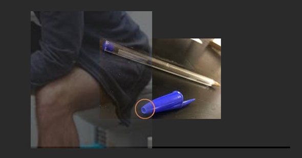 Tampa de caneta Bic fica presa no ânus de um rondoniense