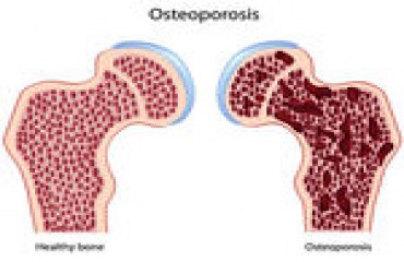 BEM-ESTAR -Osteoporose - Por Rosângela Roms