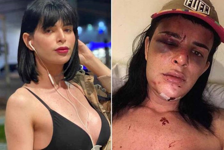 Modelo trans é agredida dentro de casa e tem o maxilar e nariz quebrados