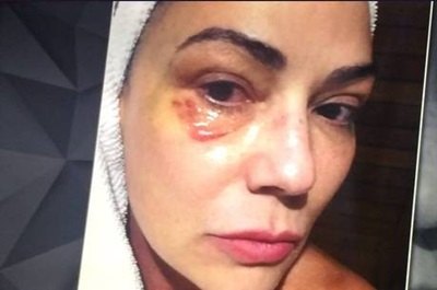 Foto mostra rosto machucado de Luiza Brunet após agressão
