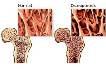 BEM-ESTAR - Prevenção da Osteoporose – Por Rosângela Roms