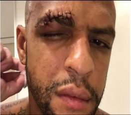 Felipe Melo mostra supercílio costurado após clássico