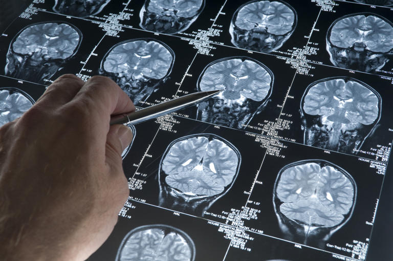 CIÊNCIA EXPLICA: Alguns sinais silenciosos que podem indicar tumor cerebral
