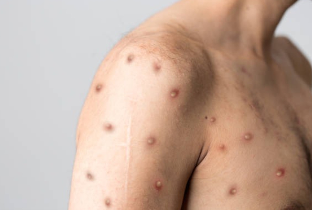ALERTA MANTIDO: Rondônia confirma 8 casos de Mpox e reforça medidas de prevenção