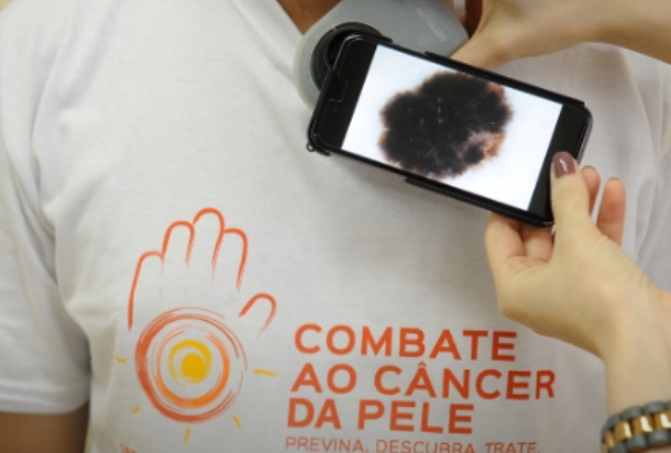 CÂNCER DE PELE: Casos no Brasil saltam de 4 mil para mais de 72 mil em 10 anos