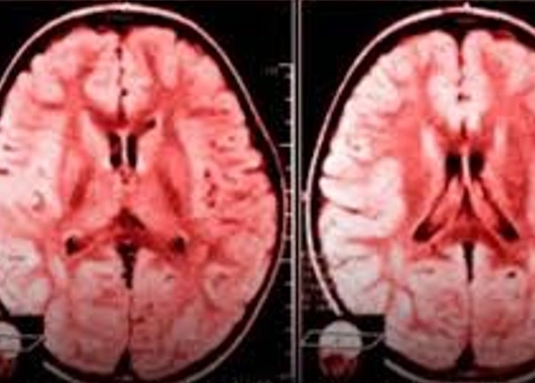VITIMISMO: Hábito de reclamar danifica o cérebro humano