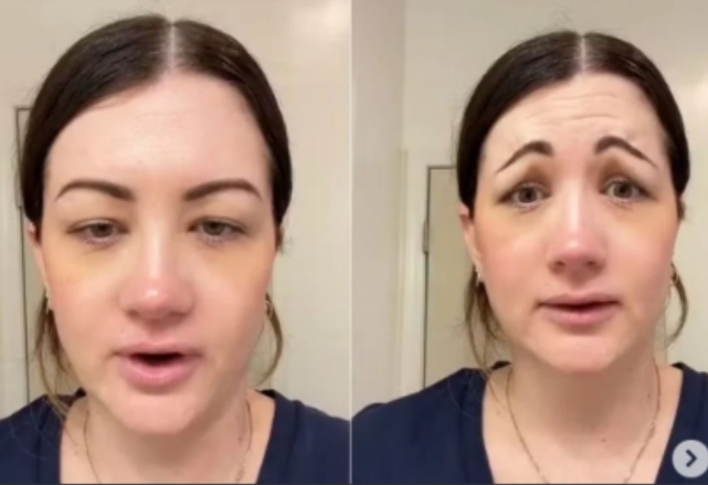 ESTILO DE VIDA: Botox dá errado e mulher fica com cara de ‘palhaço triste’