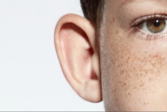 'ORELHA DE ABANO': Além da estética tem outro impacto desta condição 