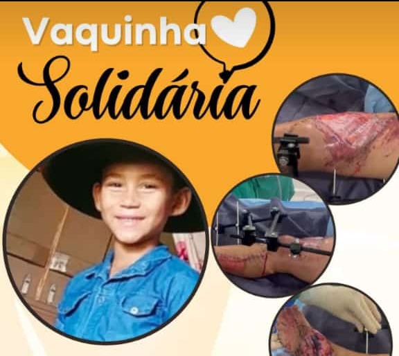 SOLIDARIEDADE: Criança que sofreu grave acidente necessita de ajuda para tratamento