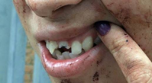 CRUEL: Após ficar dois dias fora de casa, marido bêbado quebra dente de mulher na porrada