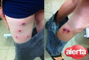 Jovem é baleado com tiro de escopeta nas pernas 