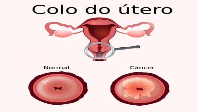 PRECAUÇÃO: Sintomas de câncer do colo de útero devem ser analisados