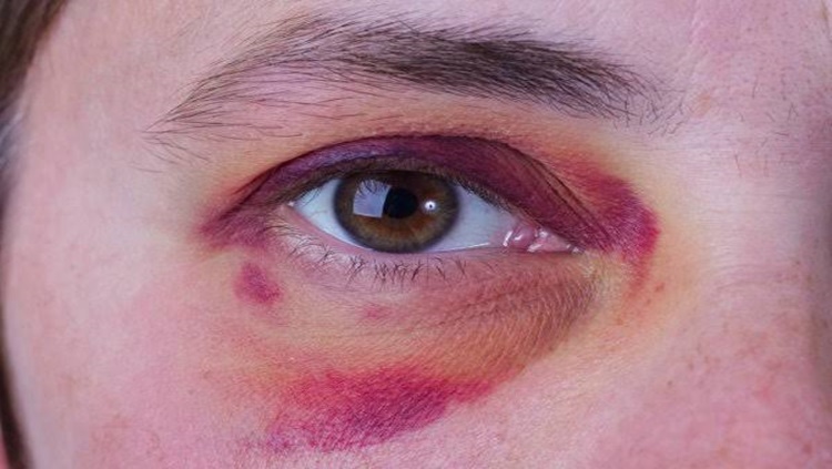 HEMATOMAS: Mulher é agredida com vários socos no rosto por amigo enciumado