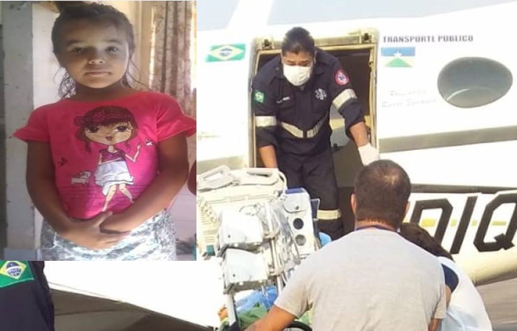 ESTADO É GRAVE: Menina de 6 anos é atingida por fogo durante churrasco em família