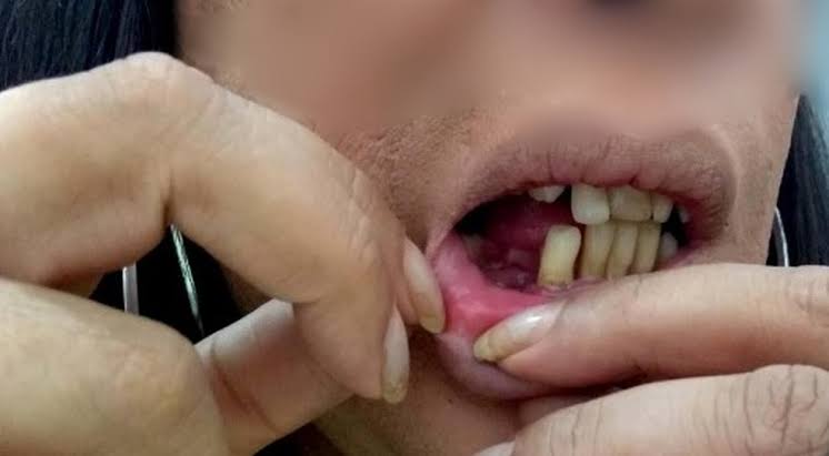 NA FESTA: Mulher tem dois dentes quebrados ao ser agredida pela sobrinha e marido dela