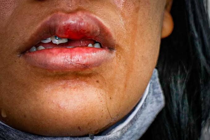 CRUEL: Marido violento quebra dois dentes da mulher com socos e foge