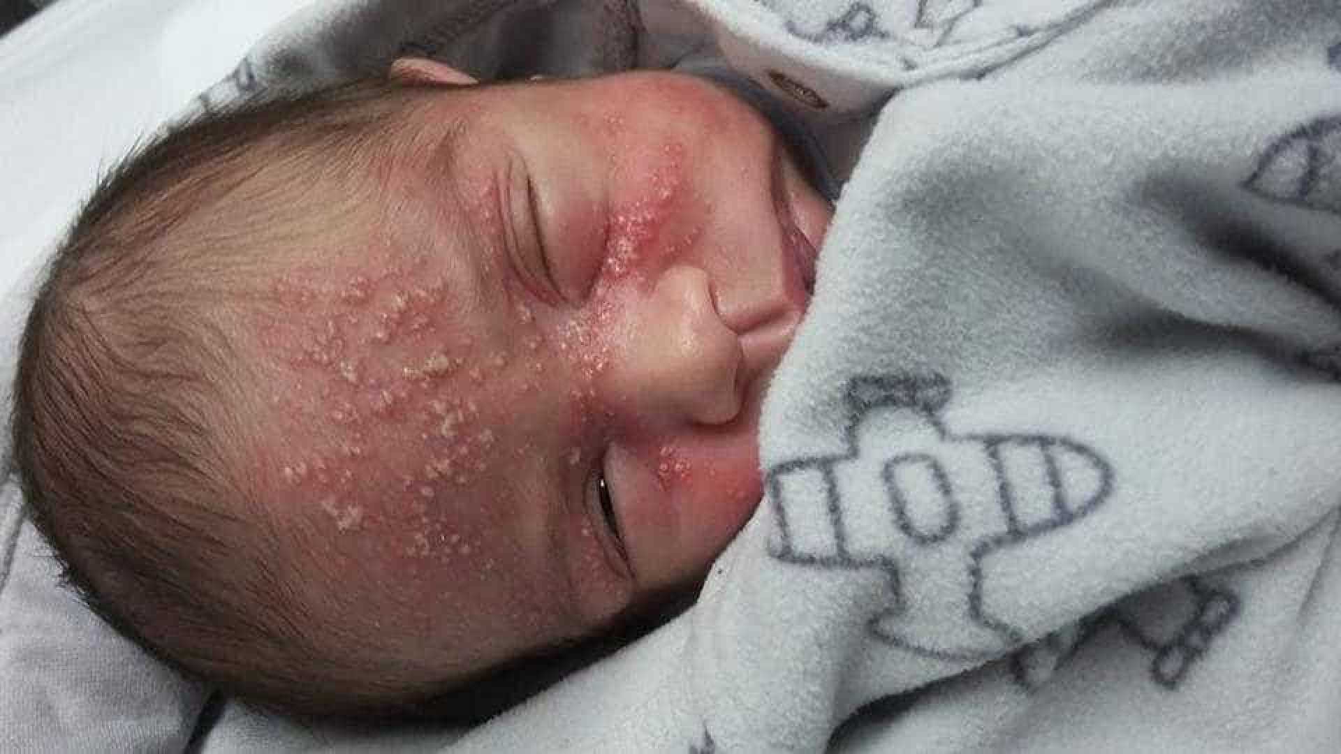 DOENÇA: Bebê de 17 dias contrai herpes após beijo de adulto