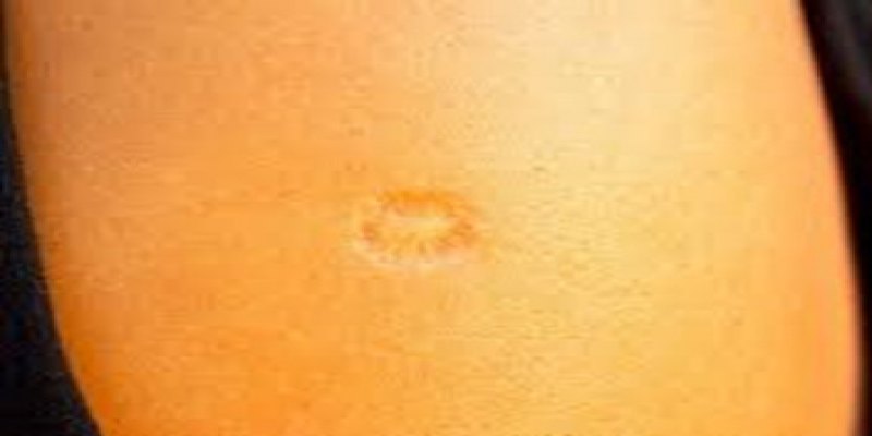 PARA SEMPRE: Marcas de vacinas antigas revelam avanço histórico da imunização no Brasil todo
